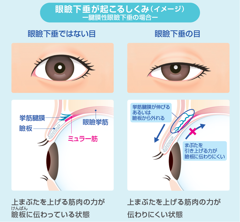 眼瞼下垂が起こる仕組み
