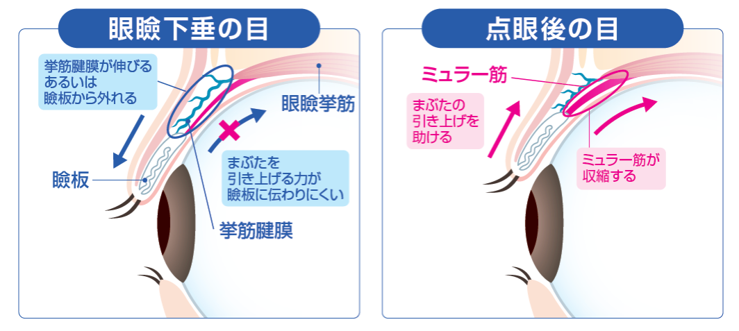 点眼後の目